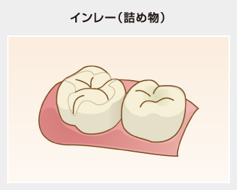 インレー（詰め物）