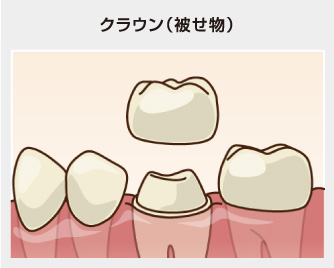 クラウン（被せ物）