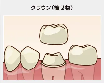 クラウン（被せ物）