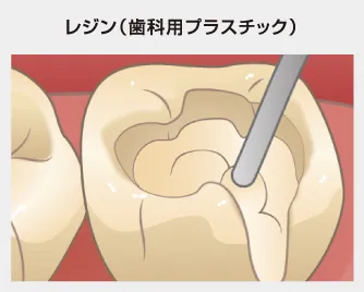 コンポジットレジン