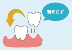 大切な天然の歯を抜く前に