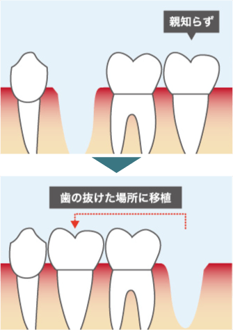 歯の移植（自家歯牙移植）