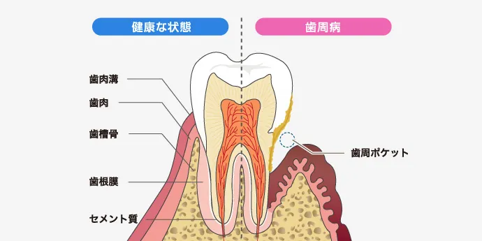 歯周病治療