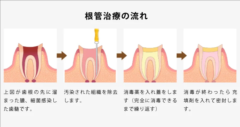 歯の根の治療（根管治療）とは