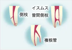 根管治療は精度が求められる
