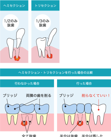 ヘミセクション／トリセクション
