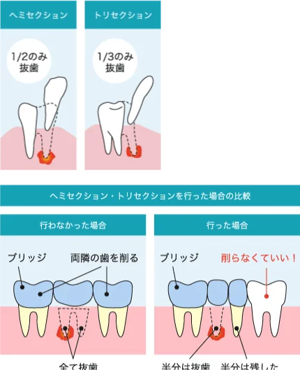 ヘミセクション／トリセクション