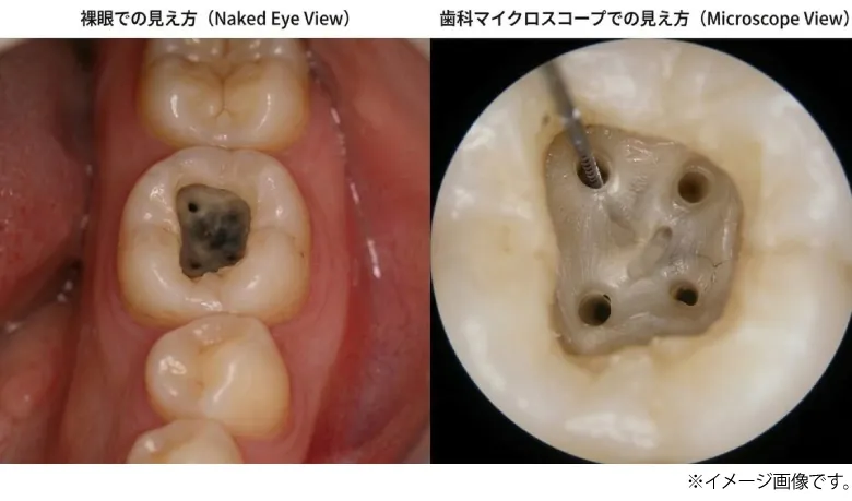 根管治療は精度が求められる